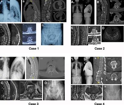 Case Report: Identifying Andersson-Like Lesions in Diffuse Idiopathic Skeletal Hyperostosis